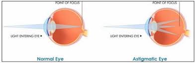 ce este miopia astigmatică