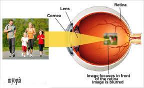 retina miopia)